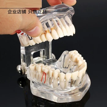 Zobni Vsadki Zob Model Poučevanje Študija Za Poučevanje Odraslih Analiza Predstavitev