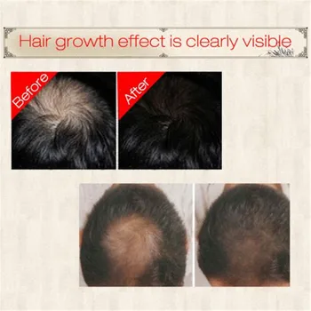 Rast dlak Rastline Bistvo Intenzivno Spray 30 ml Las Hitro Rast las zdravljenja Anti preprečevanje izpadanje Las Izdelkov Popravila Lase